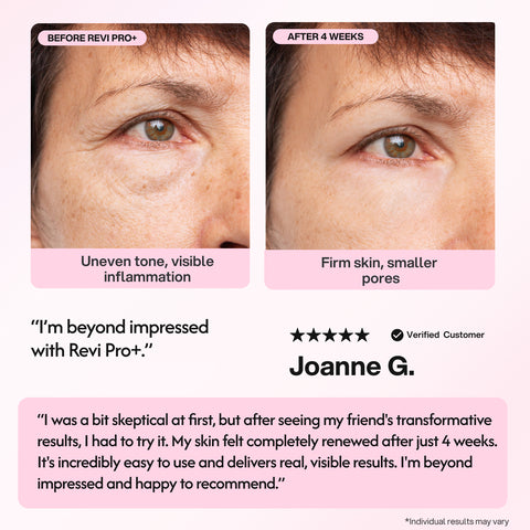Revi Pro+ Before and after comparison of skin treatment with text and a customer review.