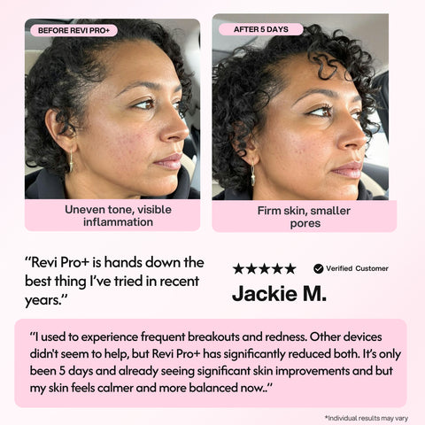 Revi Pro Before and after comparison of a woman's skin with text and a customer review on a pink background