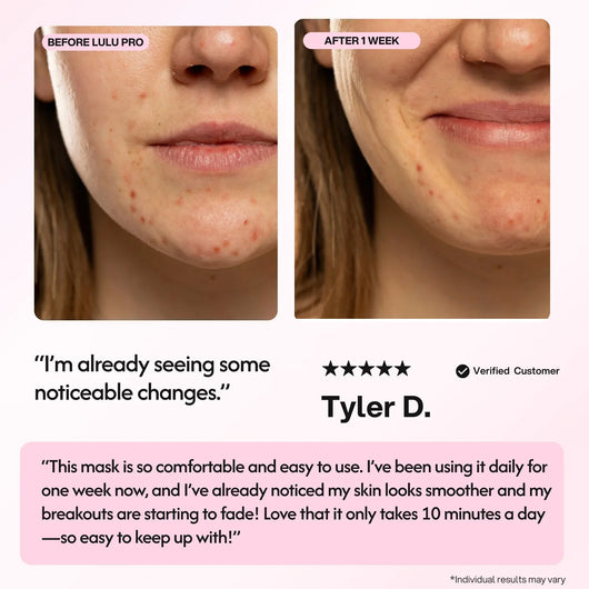 Lulu Pro LED Light Therapy Mask - Smuuv Body